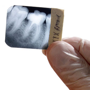 Endodonzia, patologie a carico della polpa dentaria